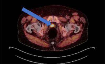 Current State of Personalized Genitourinary Cancer Radiotherapy in the Era of Precision Medicine